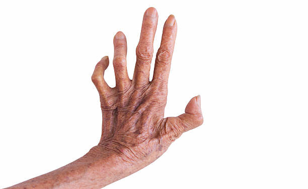 left hand of a leprosy isolated on white background